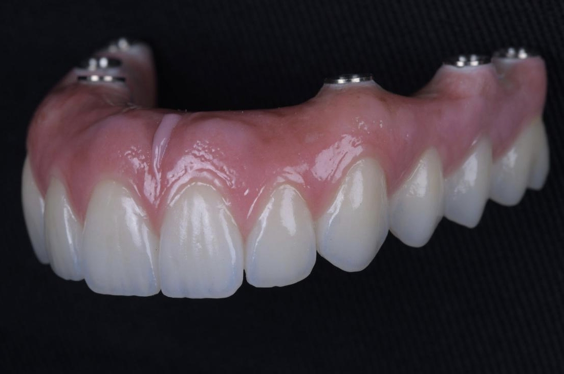 Prótese Dentária